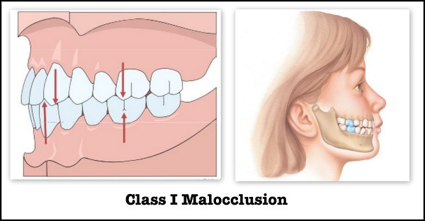 CLASS 1 Malocclusion