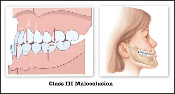 CLASS III Malocclusion