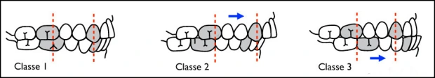 classification-malocclusion-angle-diagramme-orthodontie-sherbrooke